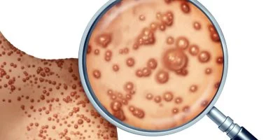 وزارة الصحة: لدينا استراتيجية واضحة للتعامل مع مرض جدرى القرود