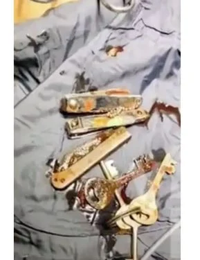 جراح يستخرج مفاتيح وقاطع أظافر وسكين من معدة هندى بسبب السوشيال ميديا